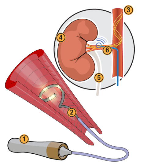 Diagramm zur Funktionsweise der renalen Denervation